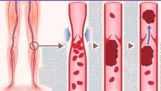 8 продуктов, которые разжижают кровь и способны предотвратить тромбоз очень важно поддерживать нормальную плотность крови, ведь ее чрезмерная густота может спровоцировать серьезные нарушения сердечно-сосудистой системы. люди, склонные к образованию